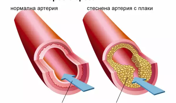 Атеросклероза