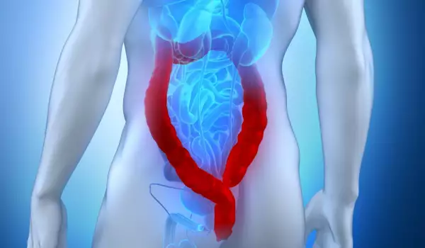 Трябва ли да се спазва диета при рак на дебелото черво?